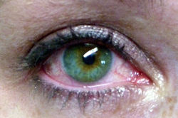 sindrome-occhio-secco