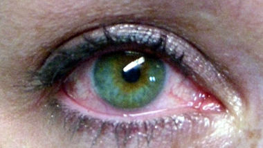 sindrome-occhio-secco